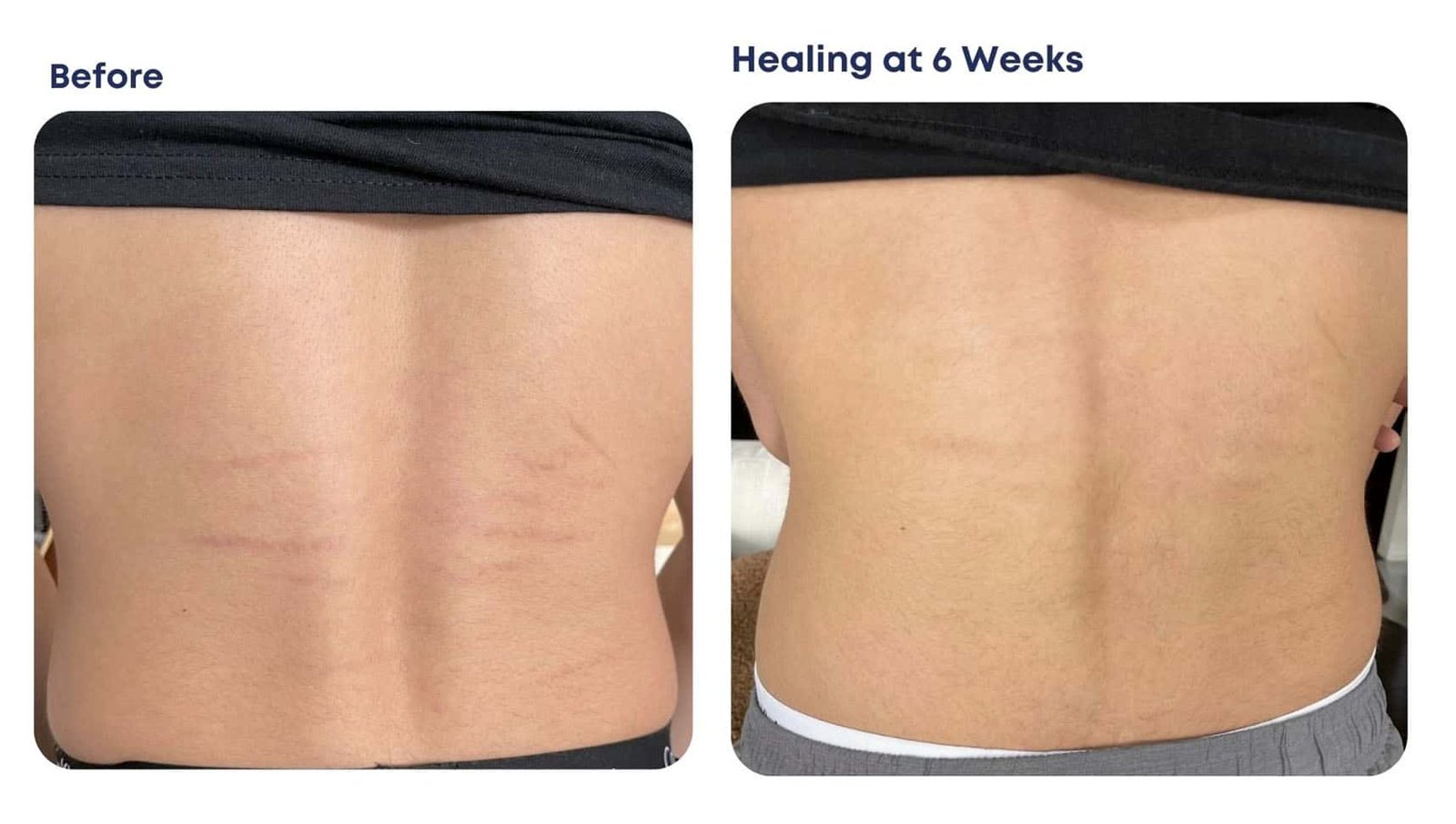 Stretch Mark Removal Before and After